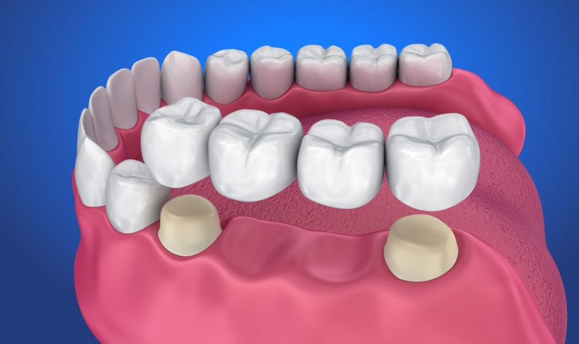 Răng bọc sứ khôi phục thẩm mỹ và chức năng