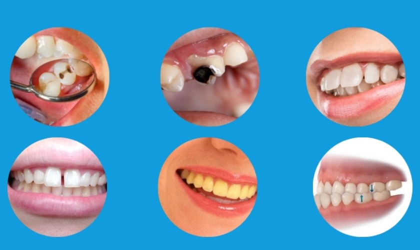 Các trường hợp có thể áp dụng răng bọc vàng