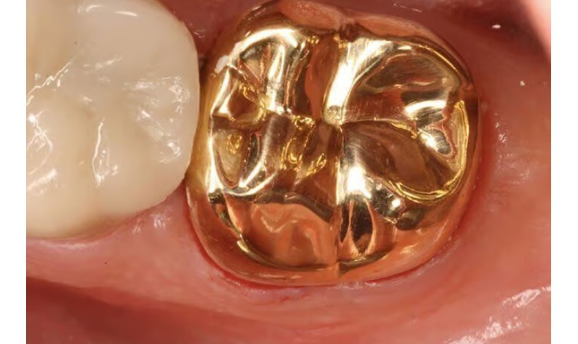 Răng vàng có tuổi thọ cao, an toàn với cơ thể