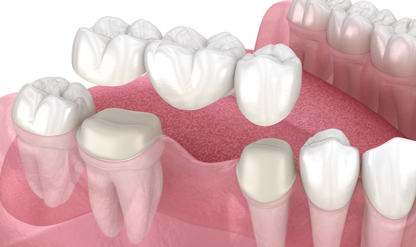 Răng sứ titan giúp khôi phục thẩm mỹ và chức năng