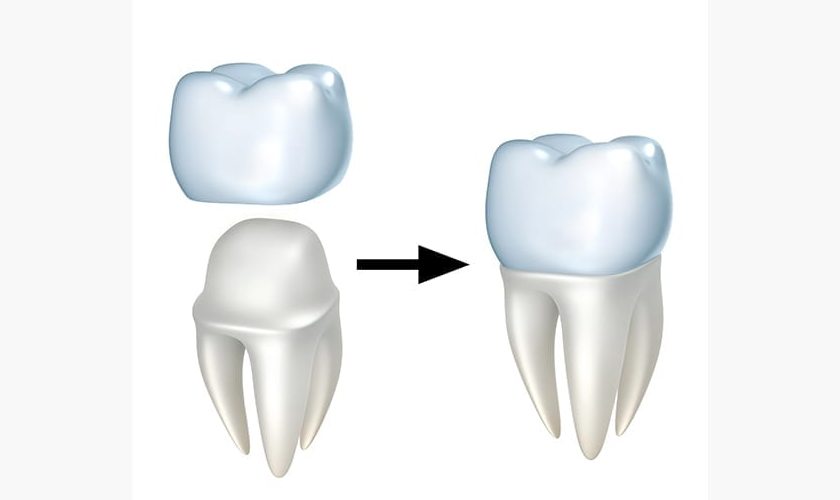 Răng sứ titan chủ yếu được chỉ định cho răng hàm