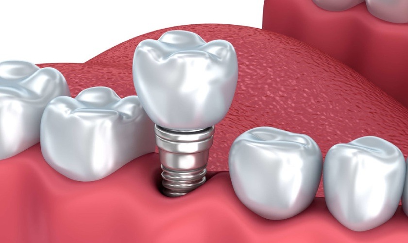 Răng sứ trên implant có độ bền chắc rất cao