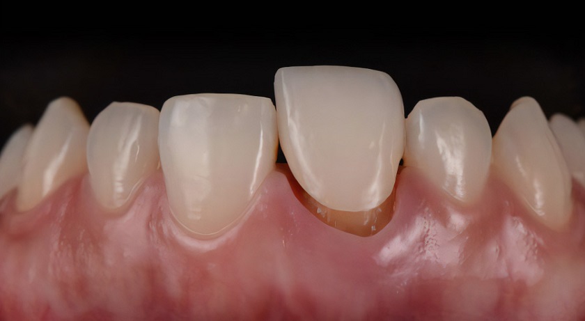 Răng sứ bị lung lay khi được bọc sai kĩ thuật