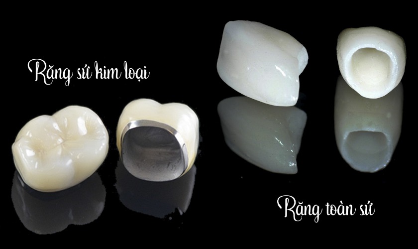 Răng sứ kim loại và răng toàn sứ