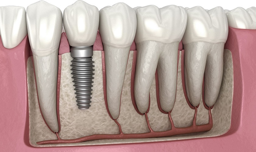 Trồng răng sứ giá cả bị ảnh hưởng bởi những lý do nào?