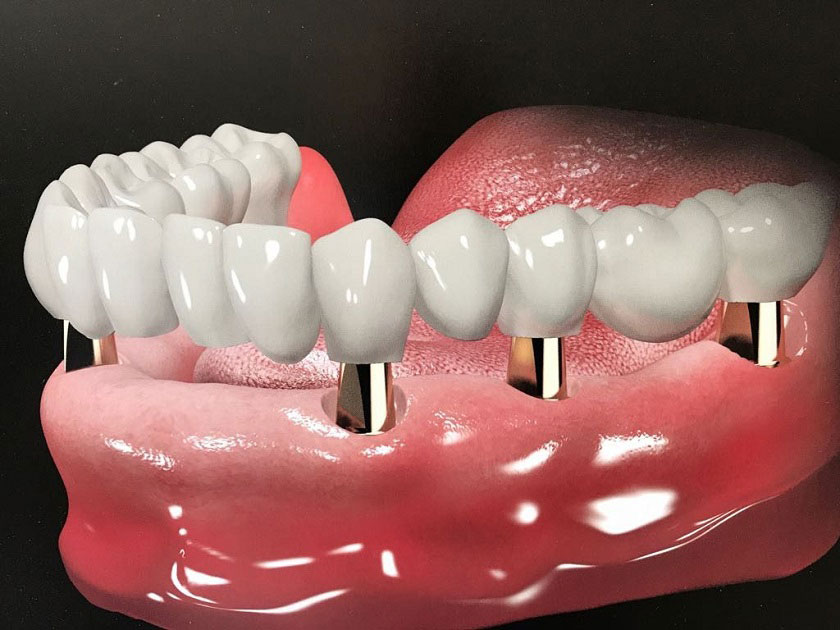 Phương pháp trồng răng sứ trên implant