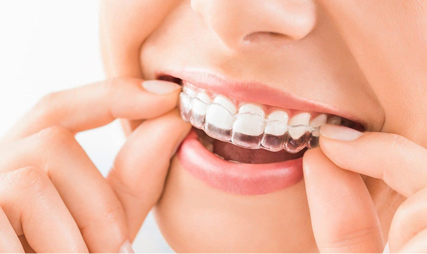 Niềng răng trong suốt có thể tháo ra lắp vào dễ dàng