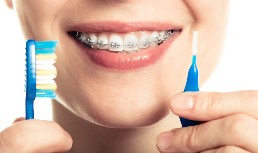 Cần vệ sinh răng miệng kỹ lưỡng khi niềng răng