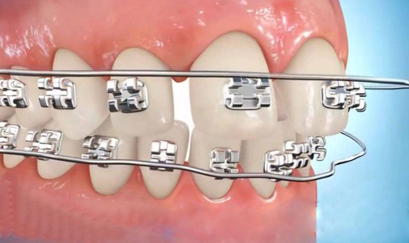 Sự cố tuột dây cung niềng răng