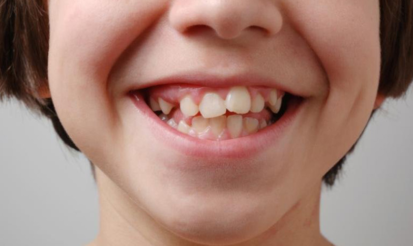 Tùy vào răng lệch ít hay nhiều, bác sĩ sẽ có phuơng pháp phù hợp