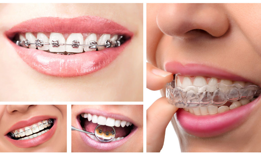 Các loại mắc cài niềng răng sẽ góp phần ảnh hưởng thời gian niềng răng