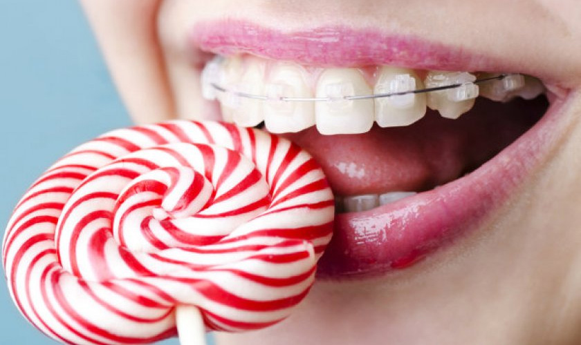 Không nên ăn thức ăn cứng trong thời gian niềng răng