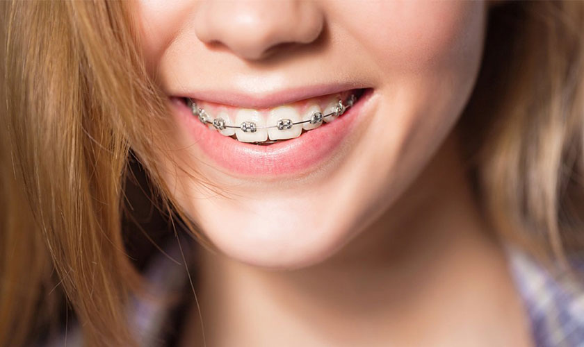 Điều trị răng móm như thế nào?