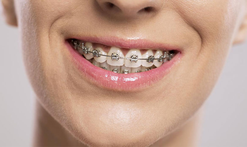 Niềng răng mắc cài kim loại