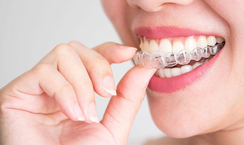 Niềng răng Invisalign