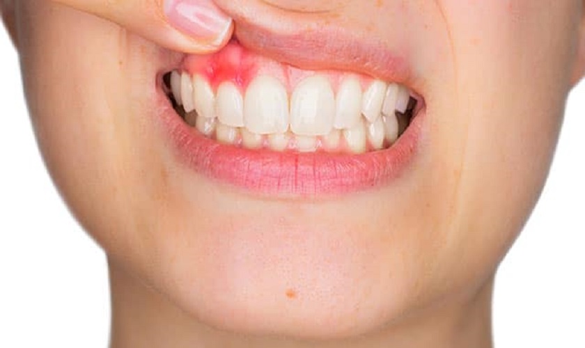 Gel từ bút làm trắng răng có thể dính vào nướu gây kích ứng