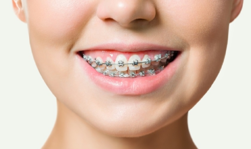 Sau khoảng 9 tháng hàm răng đã được cải thiện đáng kể