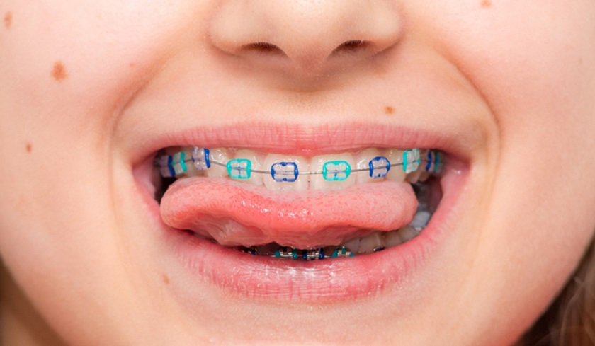 Phương pháp niềng răng với mắc cài kim loại