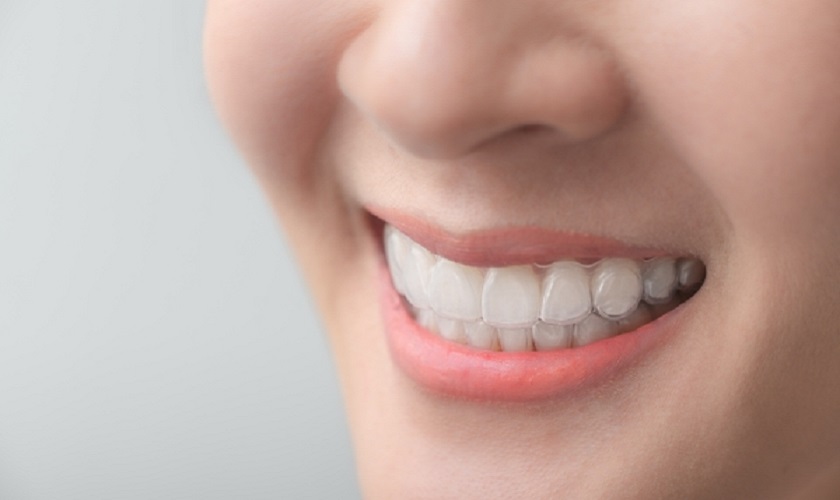 Niềng răng trong suốt Invisalign với tính thẩm mỹ vượt trội