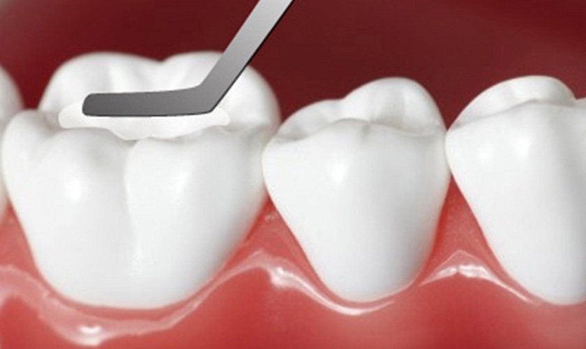 Phụ nữ mang thai có thể trám răng để điều trị bệnh sâu răng