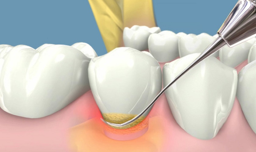 Cạo vôi răng để loại sạch mảng bám nếu khách hàng bị lung lay răng do viêm nha chu