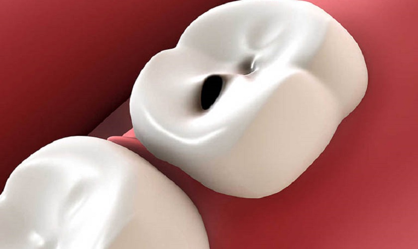 Cách chữa sâu răng bằng lá ổi chỉ phù hợp với những trường hợp răng sâu ở mức độ nhẹ