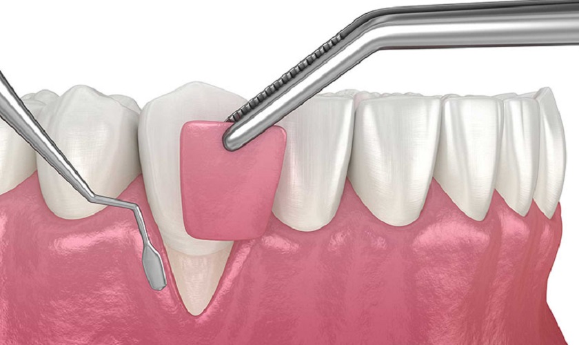 Phương pháp ghép lợi