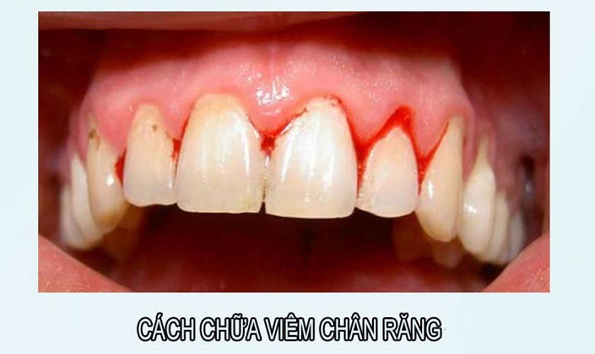 Nguyên nhân, biểu hiện và cách chữa viêm chân răng