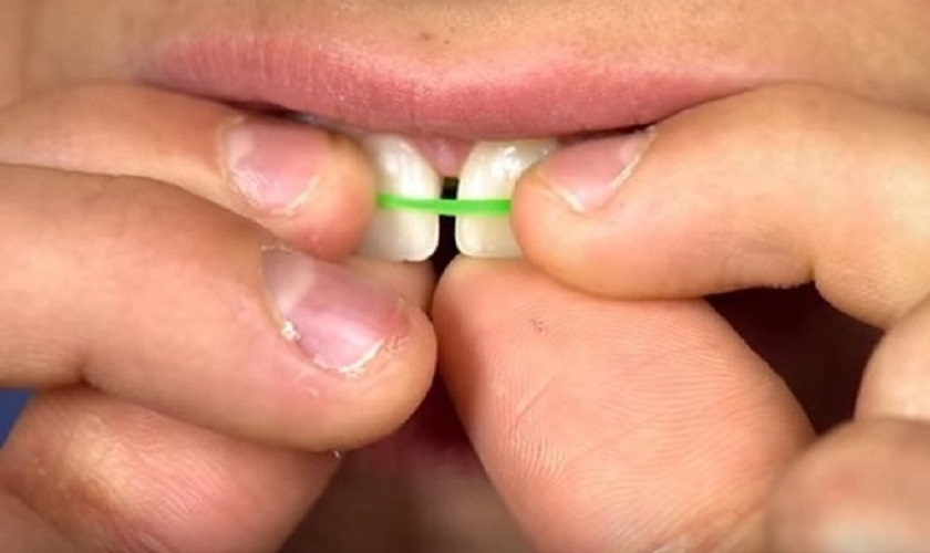 Cách điều trị răng thưa tại nhà có thể gây ảnh hưởng xấu đến sức khỏe răng miệng Cách điều trị răng thưa tại nhà có thể gây ảnh hưởng xấu đến sức khỏe răng miệng