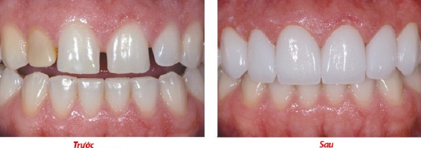 Bọc răng sứ thẩm mỹ Bọc răng sứ thẩm mỹ