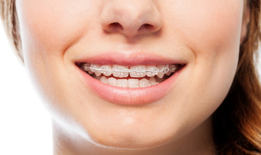 Niềng răng – giải pháp tối ưu cho người bị thưa răng Niềng răng – giải pháp tối ưu cho người bị thưa răng