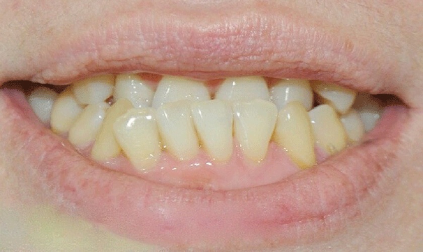 Hiện tượng răng quặp gây suy giảm khả năng ăn nhai