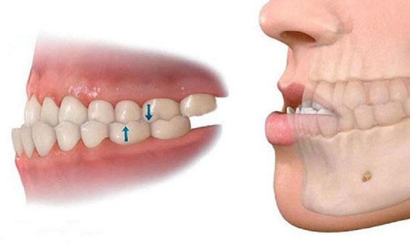 Mất cân đối gương mặt do sai lệch răng, khớp cắn