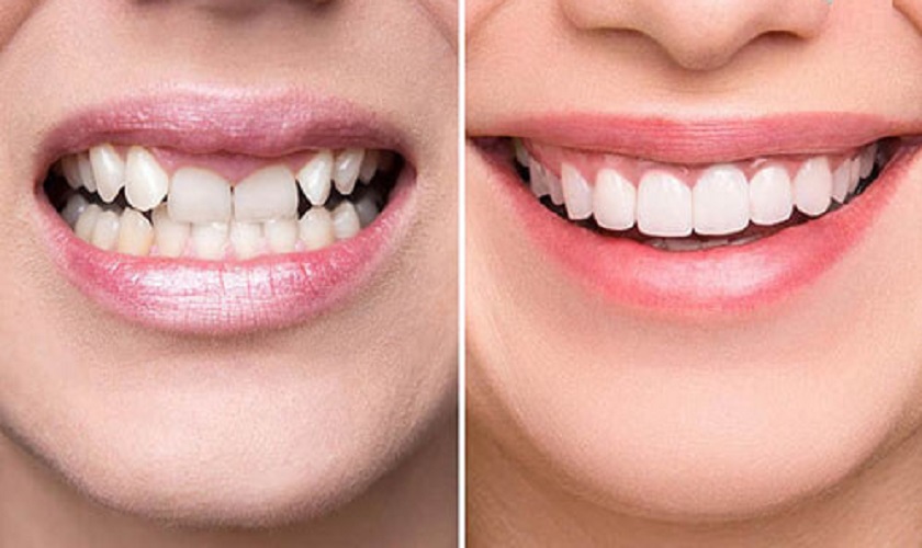 Bọc răng sứ thẩm mỹ điều trị răng cụp vào trong