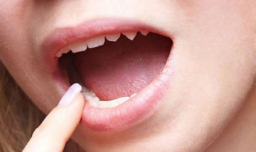3 Cách làm răng hết hô nhanh nhất hiện nay