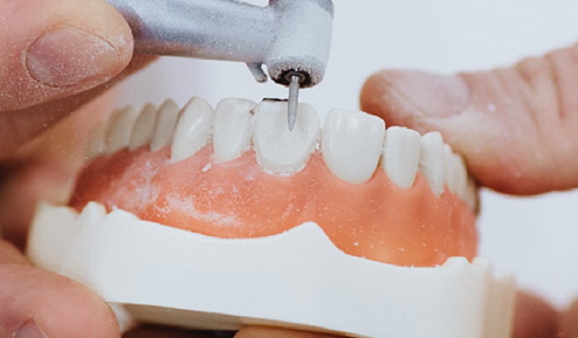 Cần mài răng thật trước khi bọc sứ