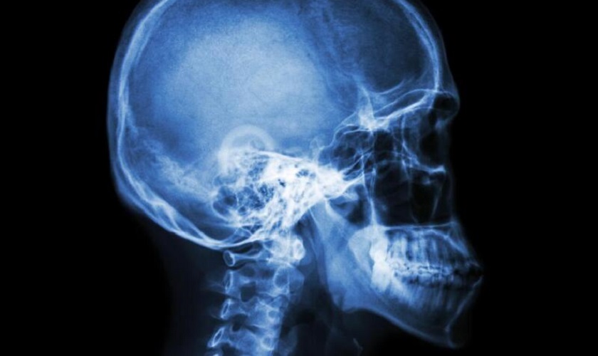 Tình trạng hô do xương