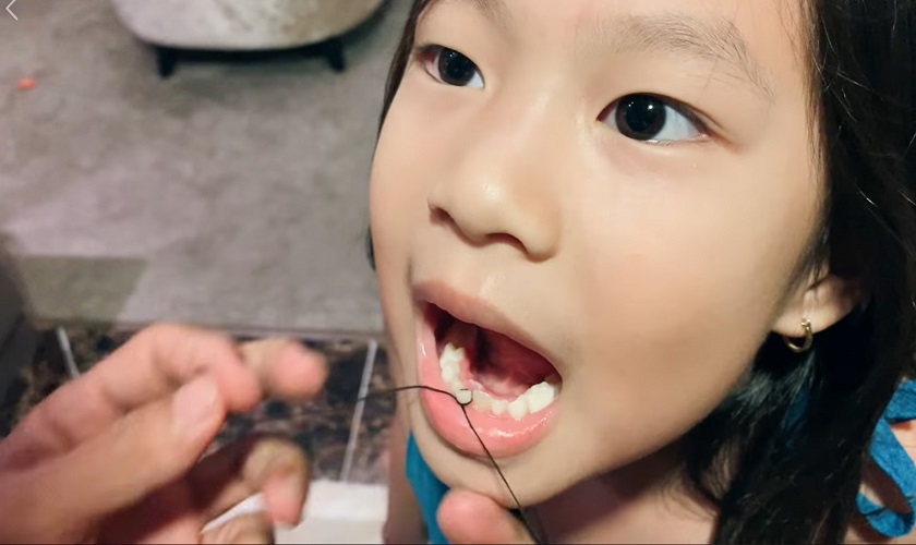 Cách nhổ răng sữa bằng chỉ tại nhà