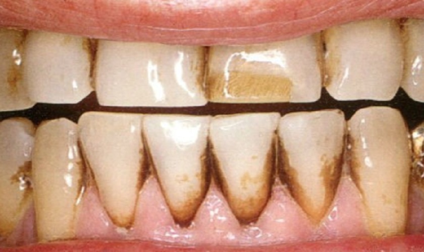 Cách trị kẽ răng bị đen tại nhà là gì?