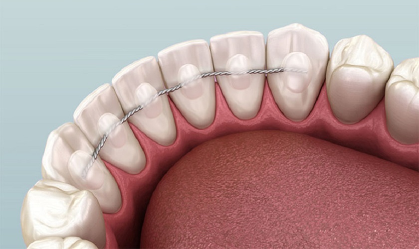 Đeo nẹp để cố định răng trong trường hợp lung lay răng do chấn thương