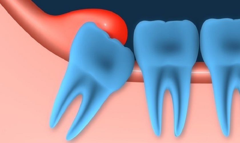 Mọc răng khôn gây sưng nướu nướu răng trong cùng