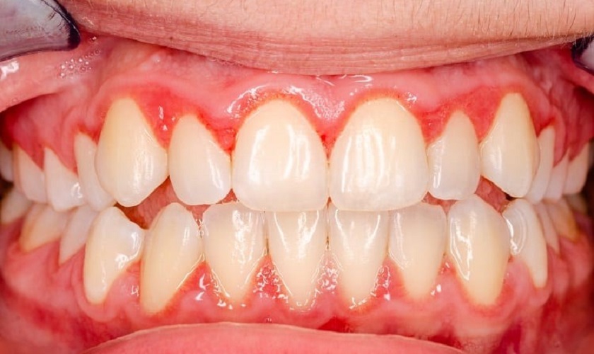 Trị viêm nướu răng tại nhà hiệu quả với túi trà xanh Trị viêm nướu răng tại nhà hiệu quả với túi trà xanh