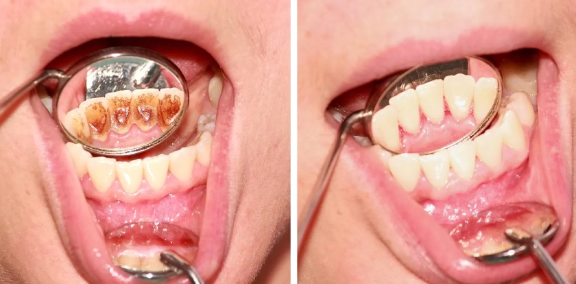 Cạo vôi răng mang đến nhiều lợi ích cho sức khỏe răng miệng