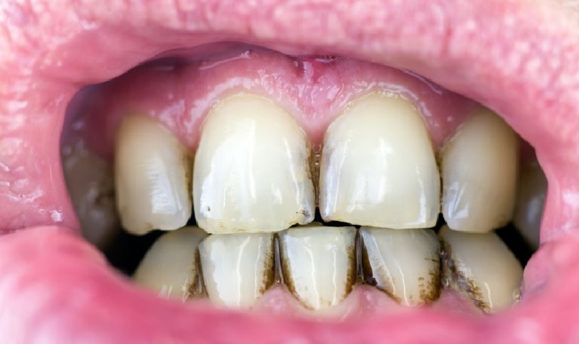 Cao răng đen là tình trạng cao răng tiến triển nặng