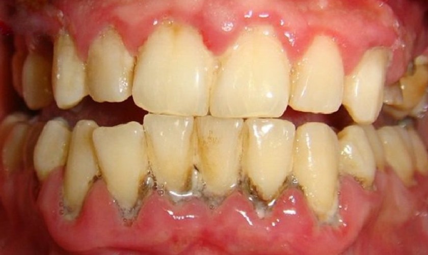 Tụt nướu do cao răng gây ra