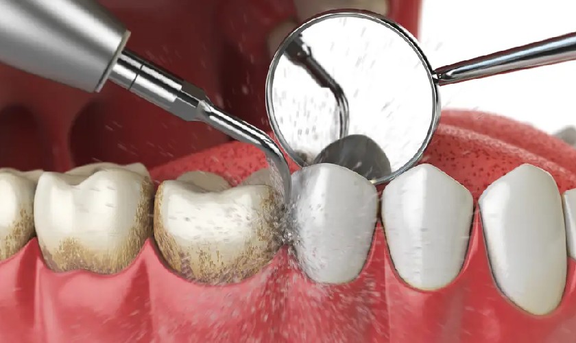 Phương pháp lấy cao răng tại nha khoa