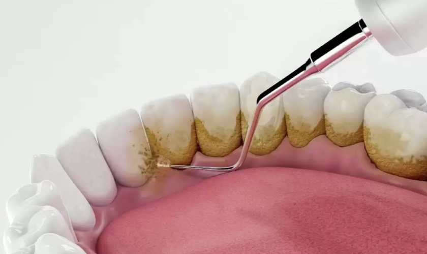 Cạo vôi răng mang đến nhiều lợi ích cho sức khỏe răng miệng