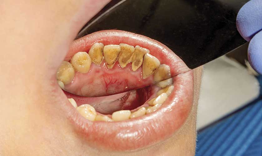 Vôi răng ảnh hưởng lớn đến thẩm mỹ và sức khỏe răng miệng