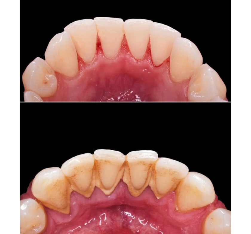 Cạo vôi răng giúp loại bỏ mảng bám, vi khuẩn trên răng hiệu quả
