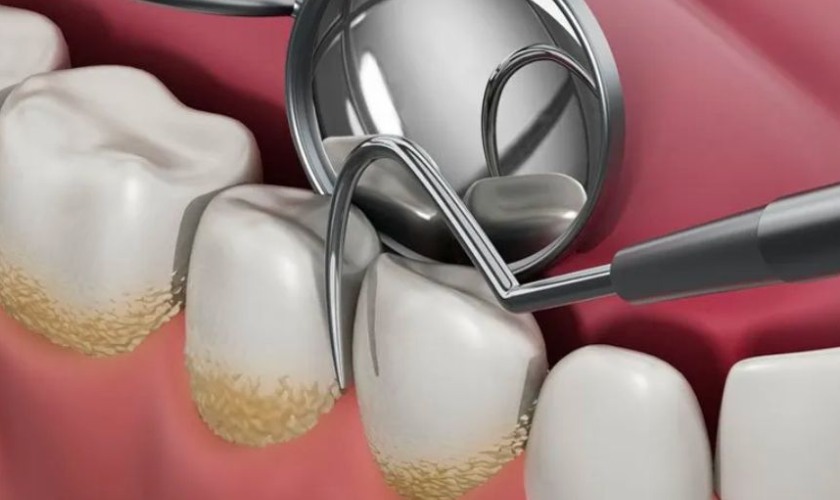 Cạo vôi răng mang đến nhiều lợi ích cho sức khỏe răng miệng